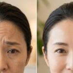 額の深い横ジワがある女性の顔と、ボトックス治療後におでこがツルッとして若々しくなった女性の顔のBefore After比較画像。
